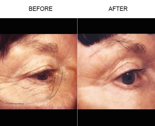Laser Skin Resurfacing Results